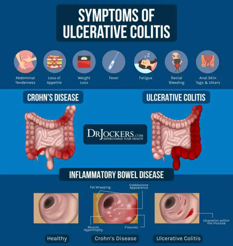 Ulcerative Colitis: Causes, Symptoms and Natural Support Strategies