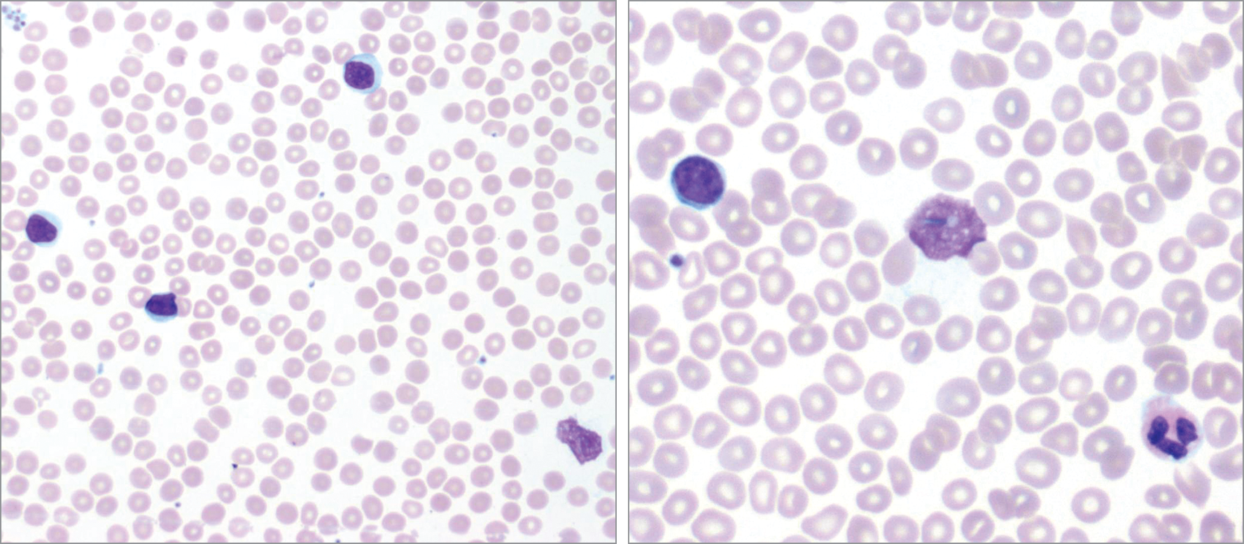 Weakness, Fatigue, and an Abnormal White Blood Cell Count