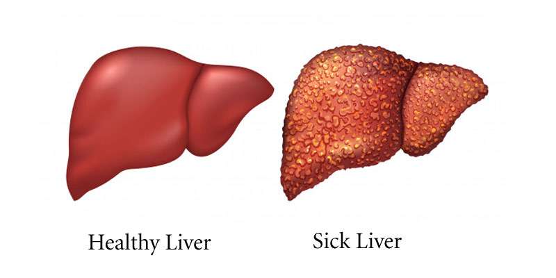 What Causes Liver Damage and The Symptoms of Liver Damage?