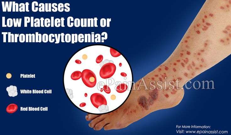 What Causes Low Platelet Count or Thrombocytopenia?