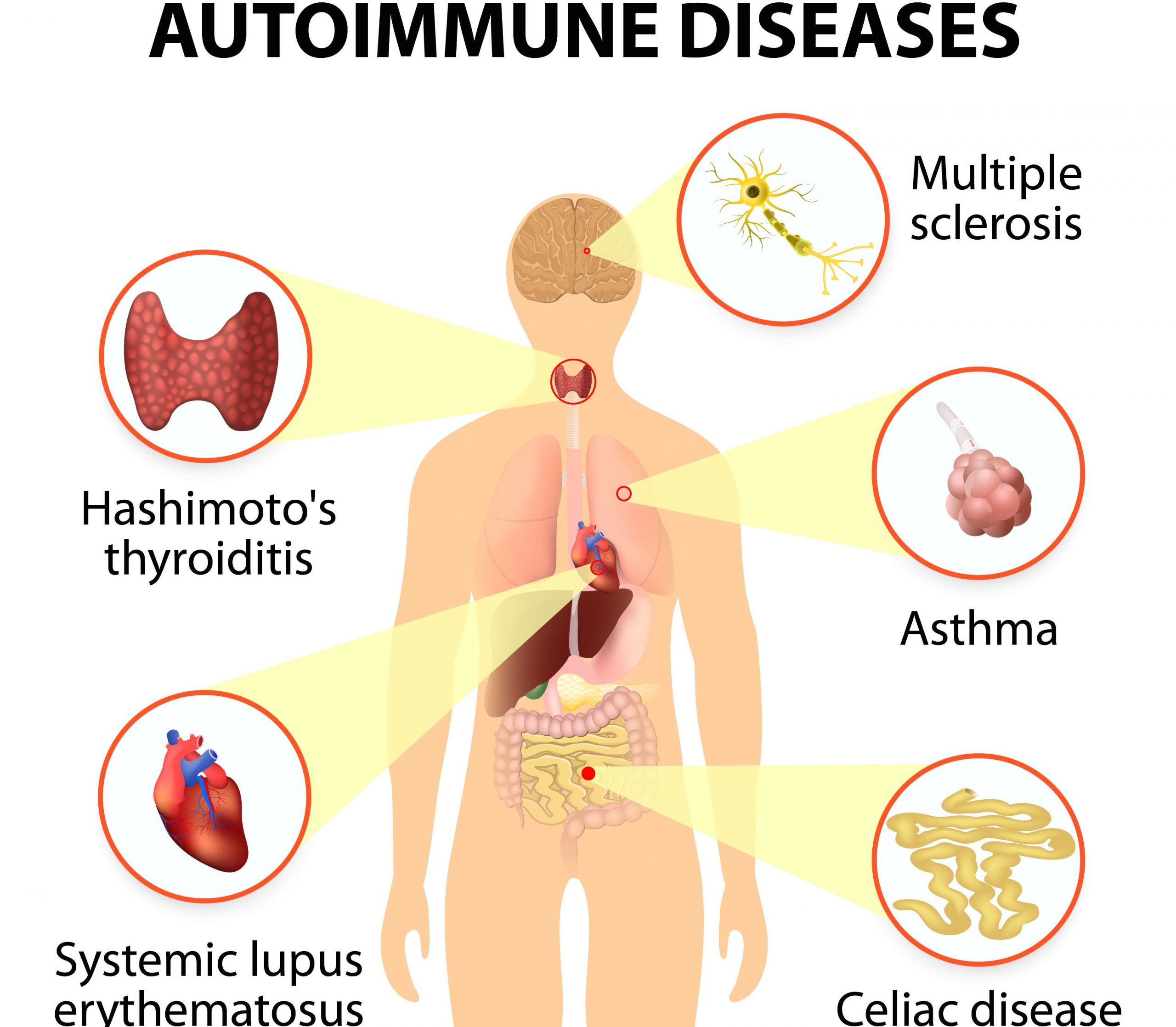 What Do You Think ALL Autoimmune Diseases Have In Common?