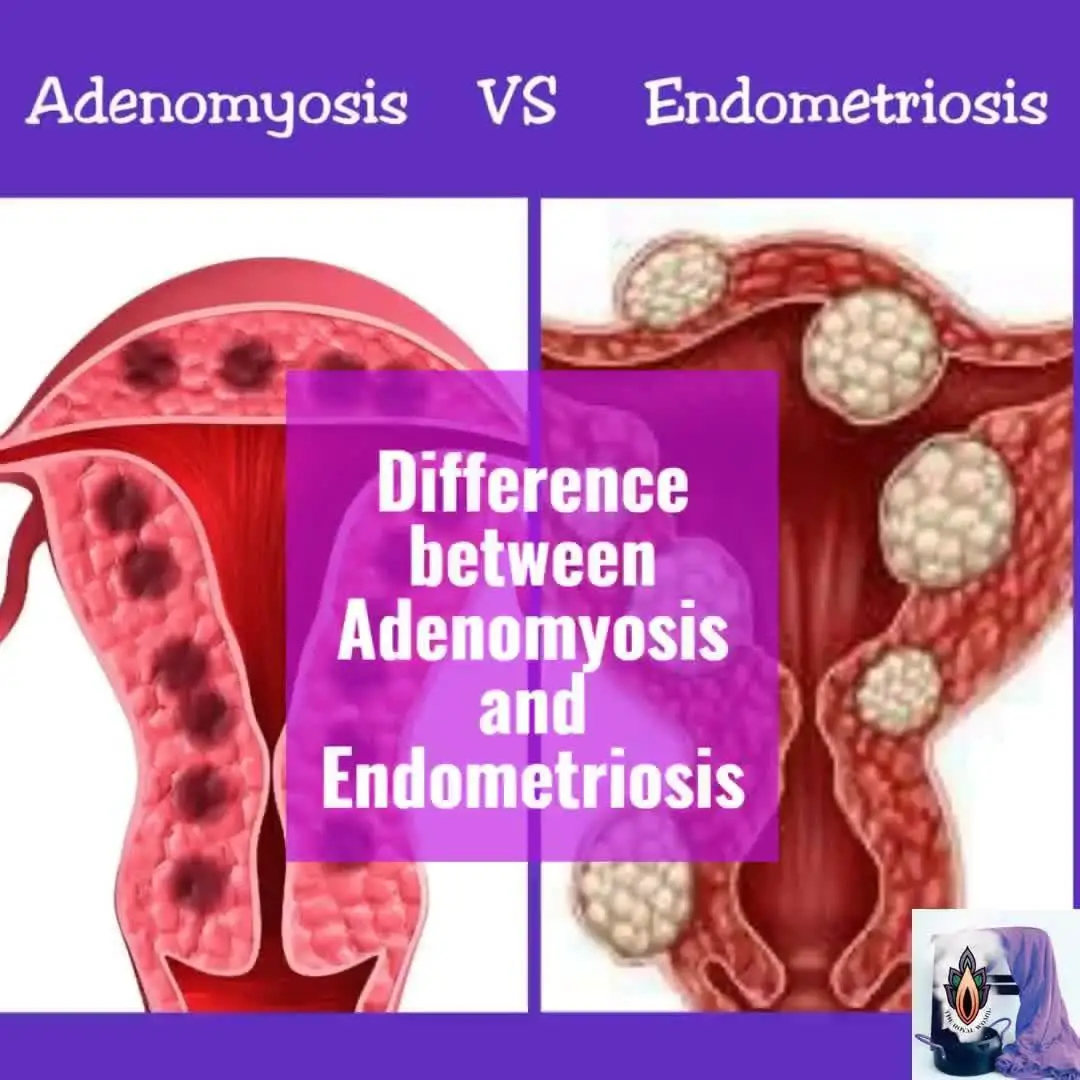 What Is Adenomyosis Vs Endometriosis