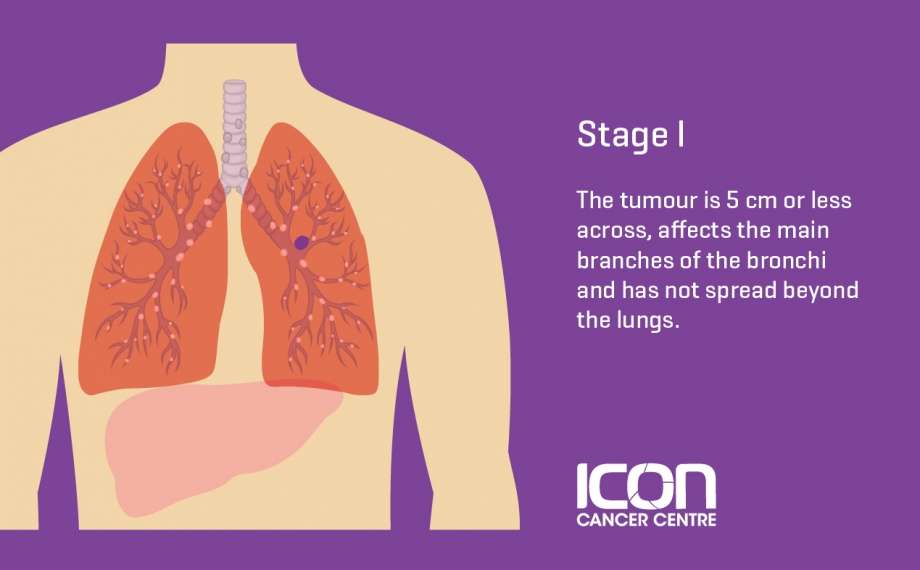 What is Lung Cancer? Lung Cancer Explained  Icon Cancer ...