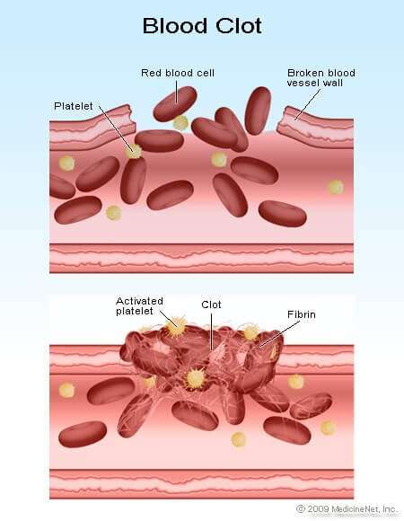 What Is Thrombocytopenia (Low Platelet Count)? Treatment ...