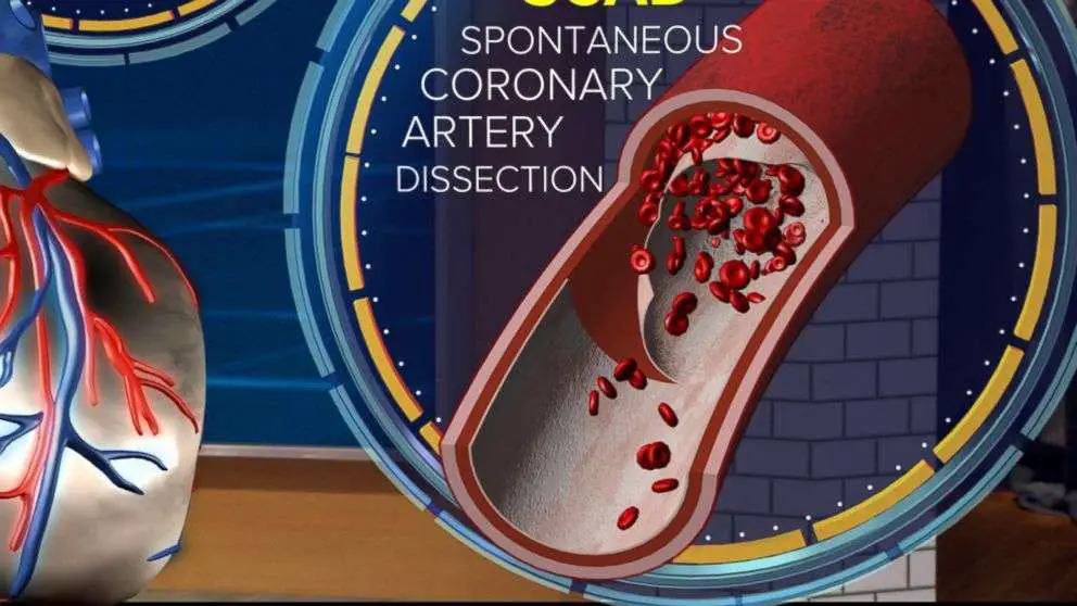 What to know about SCAD, a leading cause of heart attacks ...