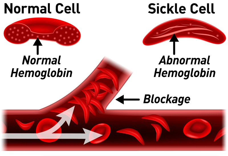World Sickle Cell Day: Causes, Symptoms And Treatment